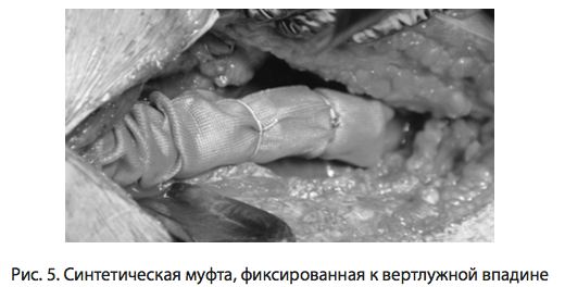 Рис. 5. Синтетическая муфта