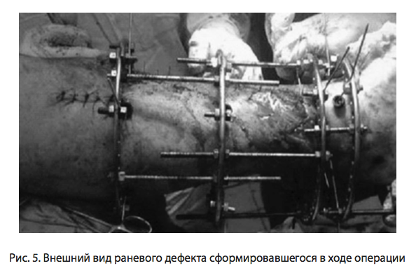 Рис. 5. Внешний вид раневого дефекта