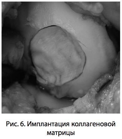 Рис. 6. Имплантация коллагеновой матрицы