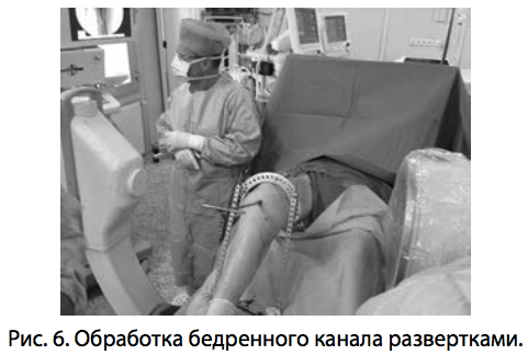 Рис. 6. Обработка бедренного канала развертками