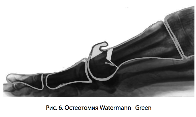 Рис. 6. Остеотомия Watermann−Green
