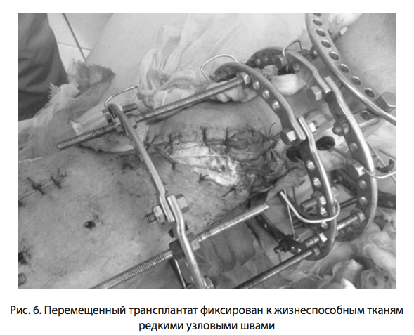 Рис. 6. Перемещенный трансплантат 