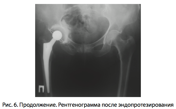Рис. 6. Продолжение. Рентгенограмма после