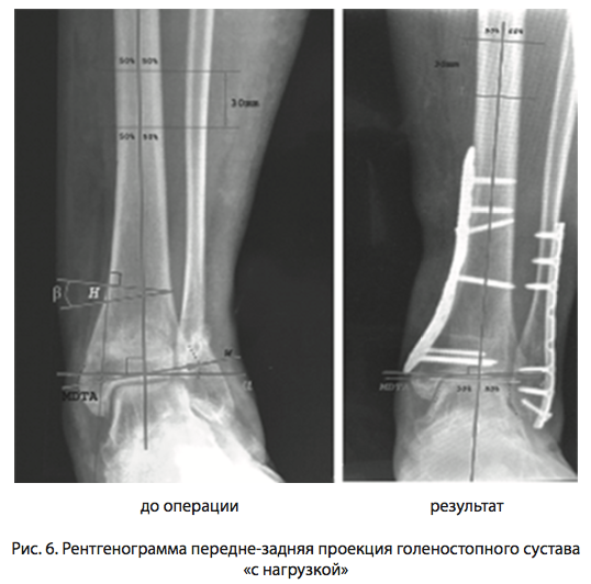 Рис. 6. Рентгенограмма переднезадняя