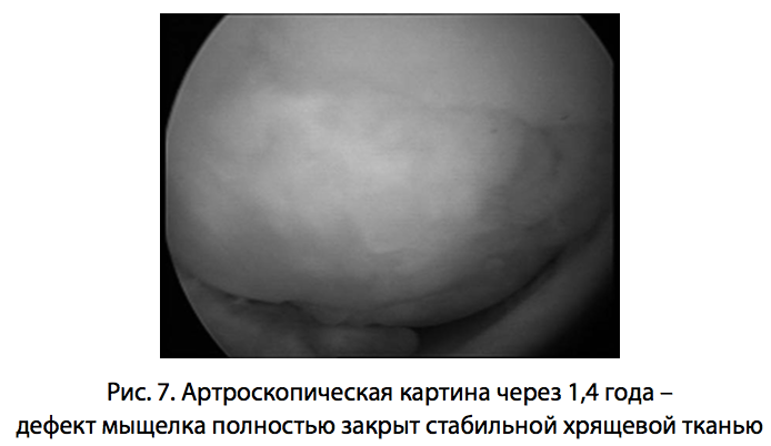 Рис. 7. Артроскопическая картина через
