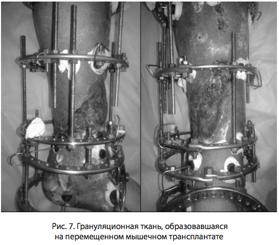 Рис. 7. Грануляционная ткань