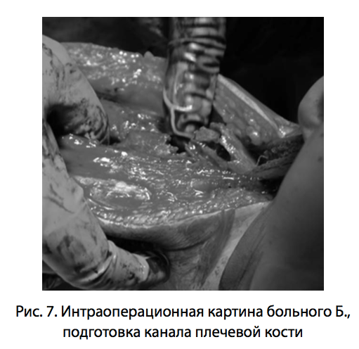 Рис. 7. Интраоперационная картина больного Б