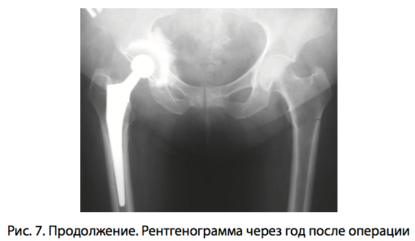 Рис. 7. Продолжение. Рентгенограмма через год