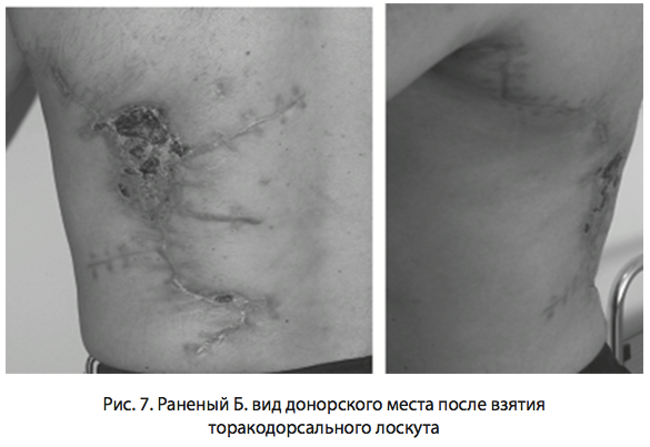 Рис. 7. Раненый Б. вид донорского места