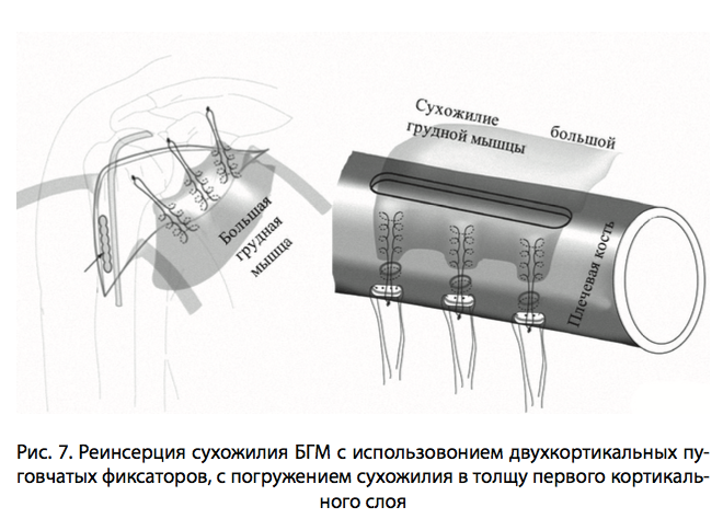 Рис. 7. Реинсерция сухожилия БГМ