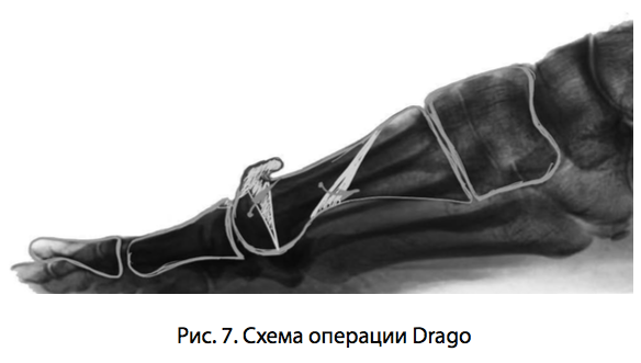 Рис. 7. Схема операции Drago