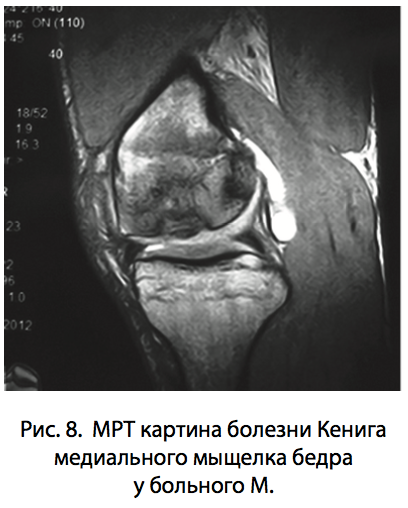 Рис. 8. МРТ картина болезни Кенига