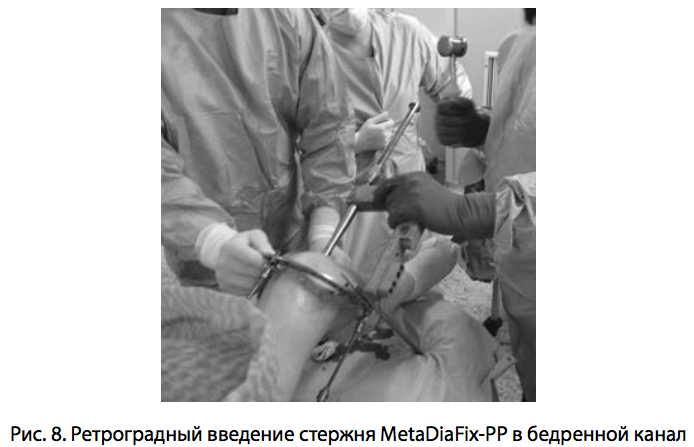 Рис. 8. Ретроградный введение стержня MetaDiaFix-PP