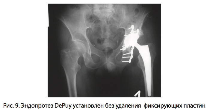Рис. 9. Эндопротез DePuy