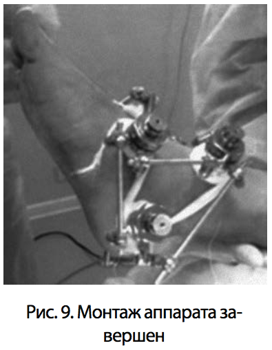 Рис. 9. Монтаж аппарата завершен