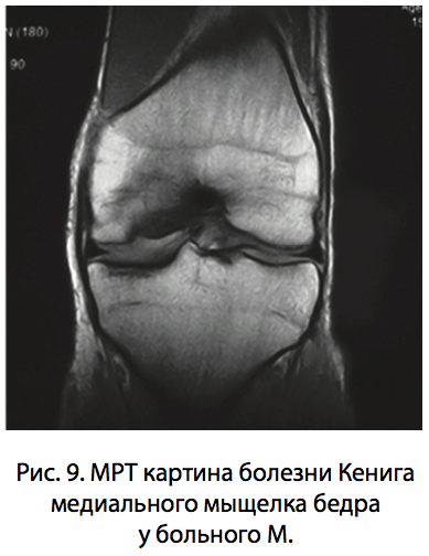 Рис. 9. МРТ картина болезни Кенига