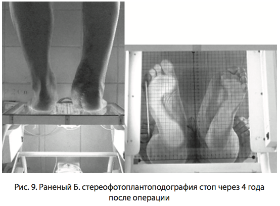 Рис. 9. Раненый Б. стереофотоплантоподография
