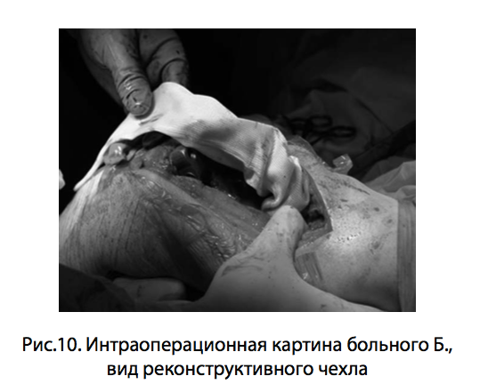 Рис.10. Интраоперационная картина больного Б