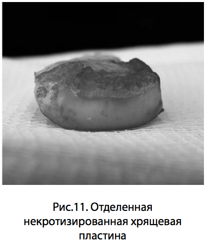 Рис.11. Отделенная некротизированная хрящевая пластина