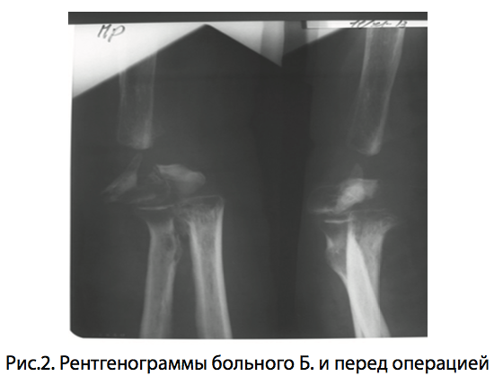 Рис.2. Рентгенограммы больного Б