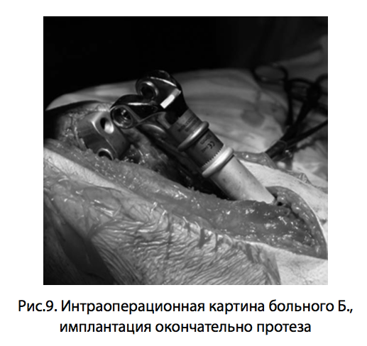 Рис.9. Интраоперационная картина больного Б